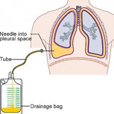 Ascitic and pleural fluid aspiration Ascitic and pleural fluid aspiration