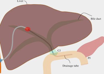 Biliary Tract Diseases
