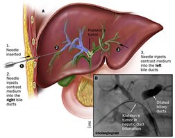 Biliary Tract Diseases