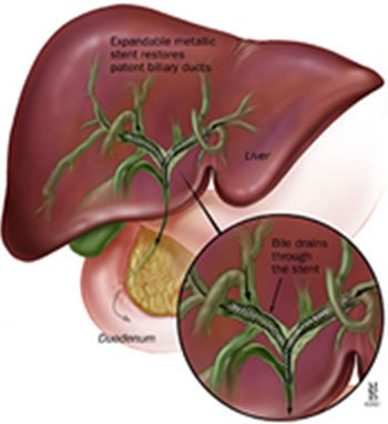 Biliary Tract Diseases