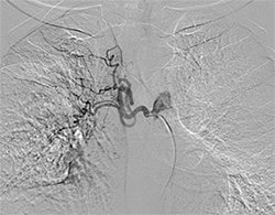 Bronchial Artery Embolization