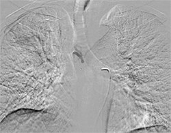 Bronchial Artery Embolization