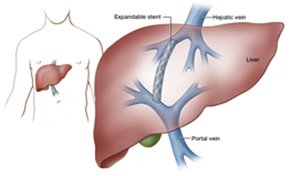 Liver Cirrhosis & Portal Hypertension (IR Treatment)