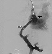 Liver Cirrhosis & Portal Hypertension (IR Treatment)