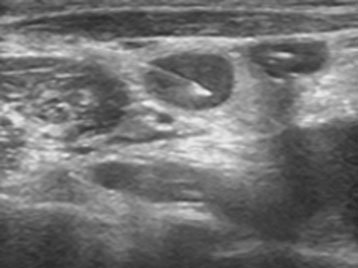 Ultrasound guided FNAC (procedure)