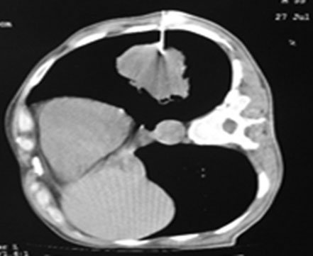 CT guided lung biopsy
