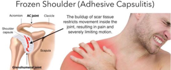 Frozen Shoulder Embolization Treatment In Delhi