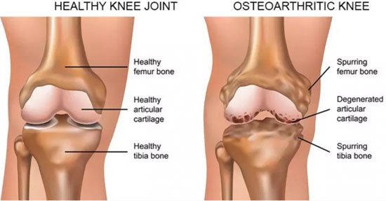 Genicular Artery Embolization In India