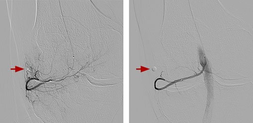 Genicular Artery Embolization In India