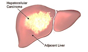Liver cancer