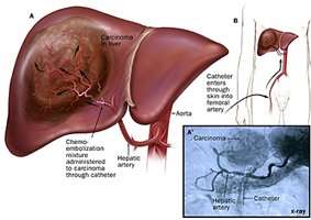 Liver cancer