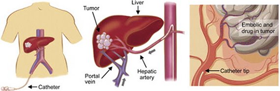 Liver cancer