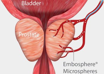 Prostatic Artery Embolization (PAE)