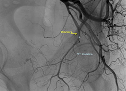 PAE Treatment in Delhi, India