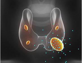 Para Thyroid Adenoma