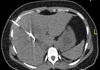 PCD in liver abcess PCD in liver abcess