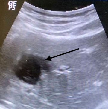 Before procedure liver abcess (arrow) Before procedure liver abcess (arrow)