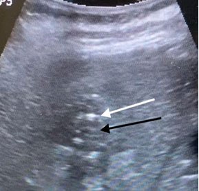 After procedure (PCD): shrunken liver abcess (black arrow) and drain (white arrow) After procedure (PCD): shrunken liver abcess (black arrow) and drain (white arrow)