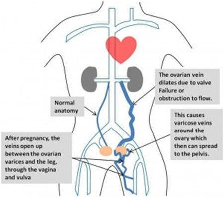 Pelvic Congestion Syndrome