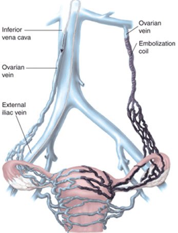 Pelvic Congestion Syndrome