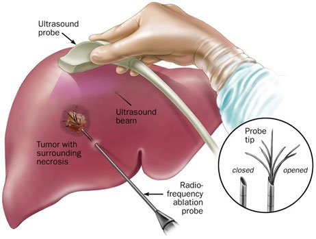 Radiofrequency ablation (RFA) and microwave ablation (MWA)