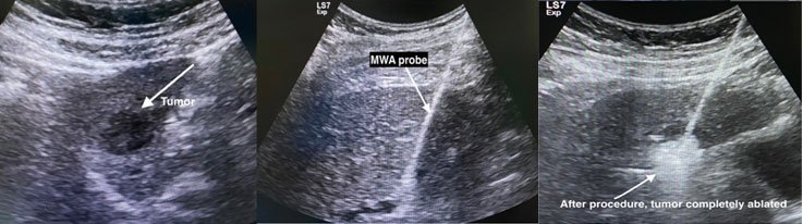 Radiofrequency ablation (RFA) and microwave ablation (MWA)