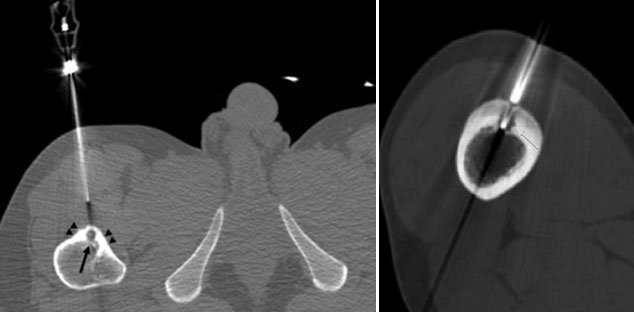 RFA (radio-frequency ablation) Of Osteoid Osteoma