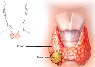 Thyroid Cancer