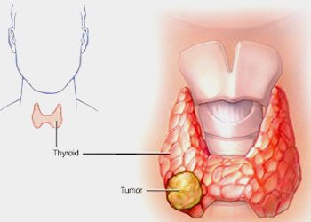 Thyroid Nodule Ablation treatment in Delhi, India
