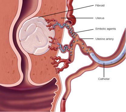 Uterine Artery Embolization Treatment In Delhi, India