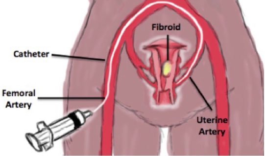 Uterine Artery Embolization Treatment In Delhi, India