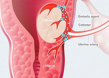 Uterine Artery Embolization For Fibroids, India