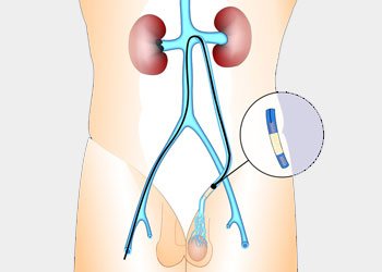 Varicocele Treatment in Delhi, India