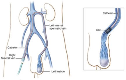 Varicocele Embolization Treatment In Delhi, India