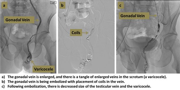 Varicocele Embolization